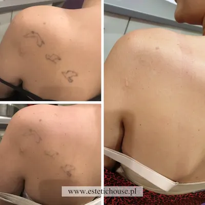 Estetic House - usuwanie tatuażu | depilacja | kosmetologia